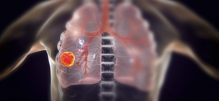 De ce apare cancerul pulmonar la cei care nu fumează: Factorii care pun viața în pericol