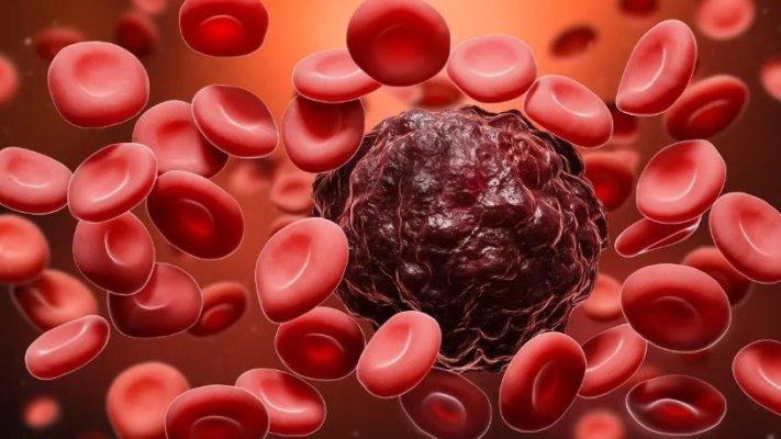 Secretul care reduce semnificativ mortalitatea în cazul cancerului de colon