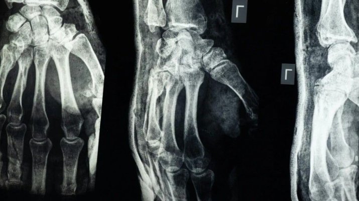 China spulberă lumea medicală cu ultima „bombă“ - lipiciul de oase care „repară“ fracturile în doar două minute