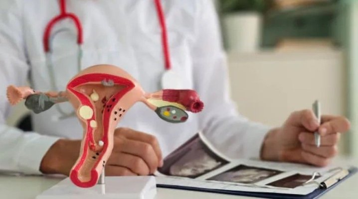 Sindromul Ovarelor Polichistice: Ce trebuie să știe fiecare femeie despre această afecțiune hormonală frecventă