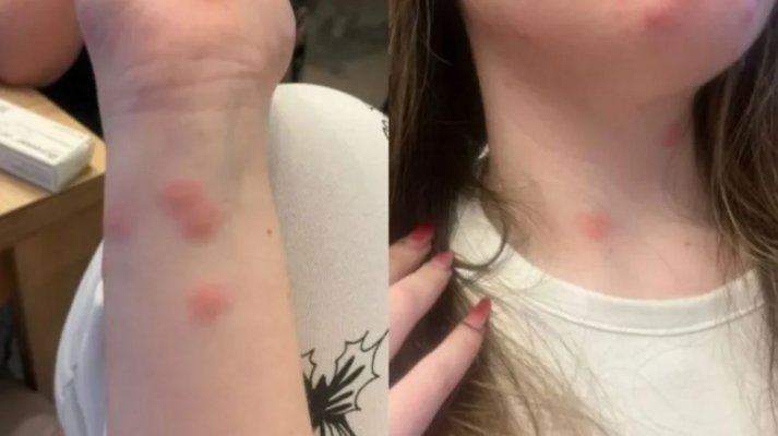 Călătorie de groază: O tânără a ajuns la spital după ce a fost mușcată de ploșnițe într-un tren CFR