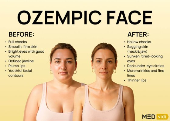 Ozempic Face: Ce schimbări estetice produce slăbirea rapidă prin injecții pentru pierdere în greutate?
