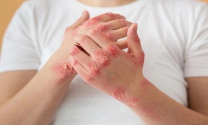 Psoriazisul este o boală din ce în ce mai elucidată astăzi. Este clasic numită „boala umilinţei“