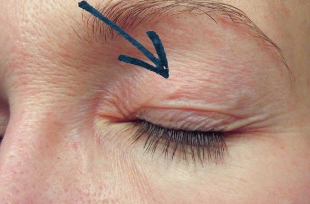 Medicii români au scos un vierme de 11 centimetri din pleoapa unei femei