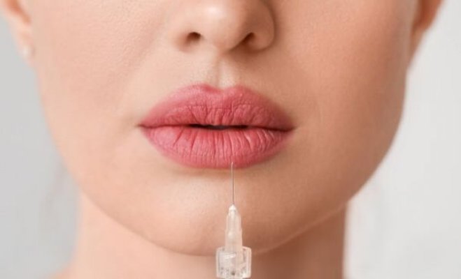 Ce înseamnă migrarea acidului hialuronic după augmentarea buzelor?