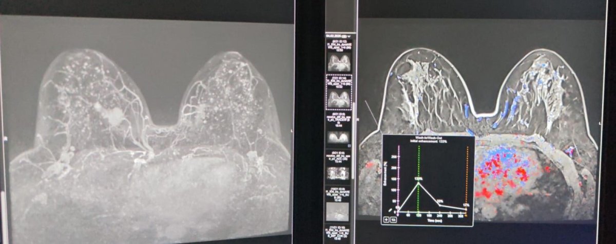 CJ Constanta investeste in sanatatea constantenilor: proceduri inovatoare in diagnosticul cancerului de san CJ Constanta investeste in sanatatea constantenilor: proceduri inovatoare in diagnosticul cancerului de san