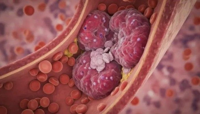 Cercetătorii au descoperit noi compuși cu potențial anticoagulant în molid