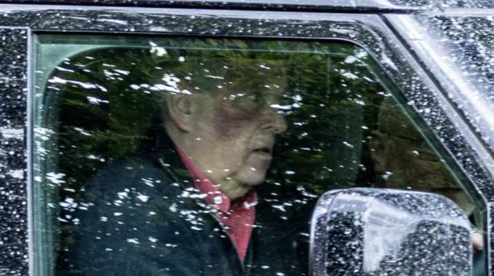 Andrew Mountbatten-Windsor, fotografiat cu o vânătaie uriașă pe față