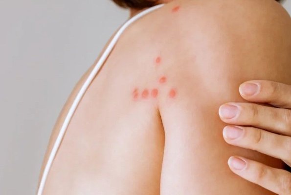 Semnele de pe piele care arată că ai ploșnițe în casă. Pot fi confundate cu înțepăturile de țânțar