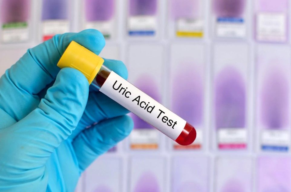 Un medic atrage atentia: Cum poate acidul uric sa duca la atac de cord Un medic atrage atentia: Cum poate acidul uric sa duca la atac de cord