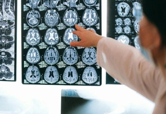 Pacienții care și-au pierdut vocea ar putea comunica din nou. Cum funcționează dispozitivul care transformă activitatea cerebrală în cuvinte