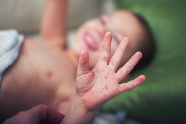 Ce este boala gură-mână-picior. Cauze, simptome și metode de prevenție la copii
