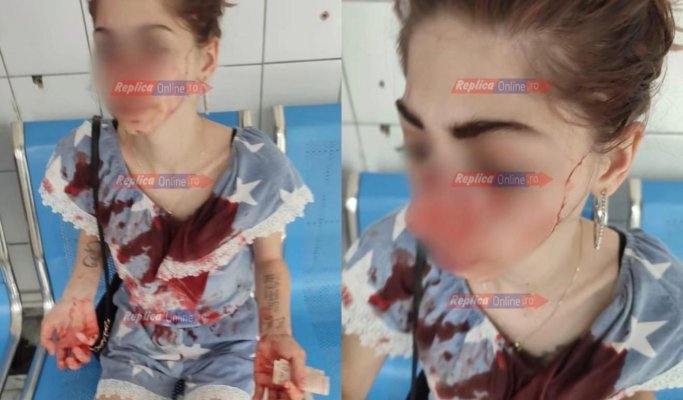Agresiune de o cruzime rară în Medgidia! O tânără de 22 de ani, desfigurată cu o rozetă din cauza unui băiat: „Mi-au spus că mă omoară dacă merg la poliție”