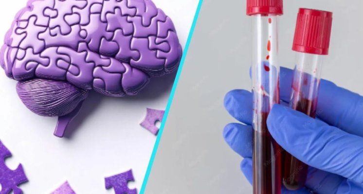 Un test de sange si o analiza genetica pot anticipa aparitia simptomelor bolii Alzheimer cu pana la sase ani