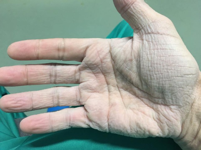 BĂTAIE DE JOC ÎN SPITALE! Așa arată mâna unui chirurg, după 12 ore de operație!