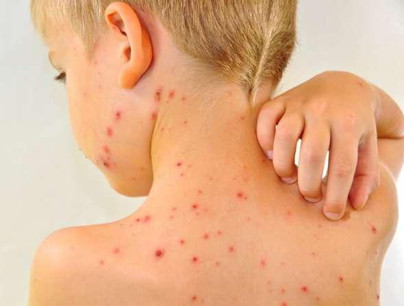 EMA evaluează un potenţial risc de encefalită asociat unor vaccinuri împotriva varicelei