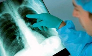 Lupta împotriva tuberculozei, afectată de pandemia de COVID-19, se redresează, dar rămâne departe de ţintă