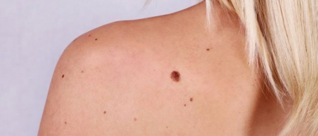 Ameliorarea prognosticului în melanomul malign