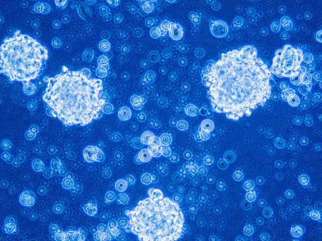 Glioblastomul: simptome, cauze, diagnostic, tratament