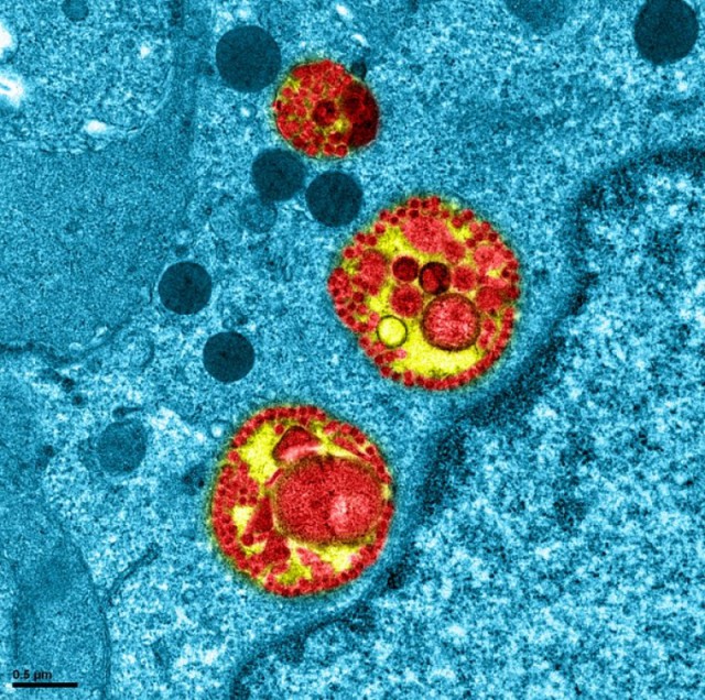 Cum arată o celulă infectată cu SARS-Cov-2: fotografie la microscop publicată de Institutul francez de sănătate publică