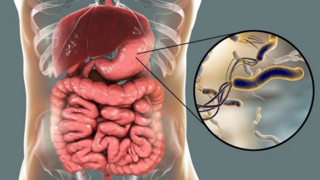 Ce este infecția cu Helicobacter pylori și cum acționează