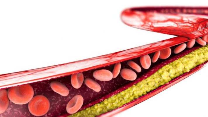Ateroscleroza coronariană – Cum o ținem sub control