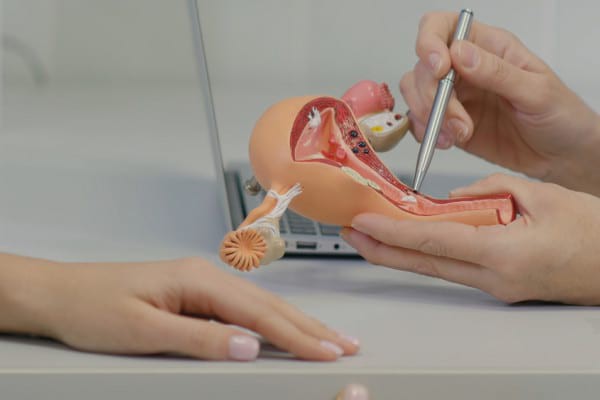 O cauza a infertilității la femei: endometrioza