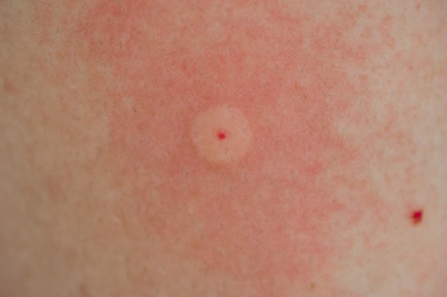 Alergia la veninul de albină și viespe - ce trebuie să știi