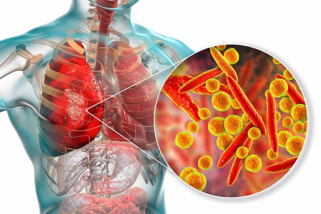 Pneumonia de aspirație: cauze, simptome, tratament