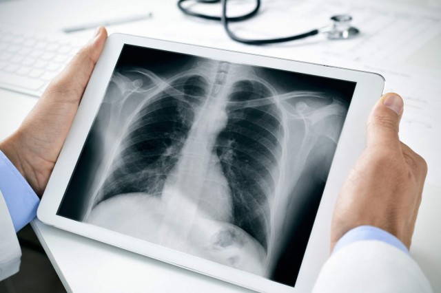 Leziunile pulmonare cauzate de țigările electronice seamănă cu arsurile chimice
