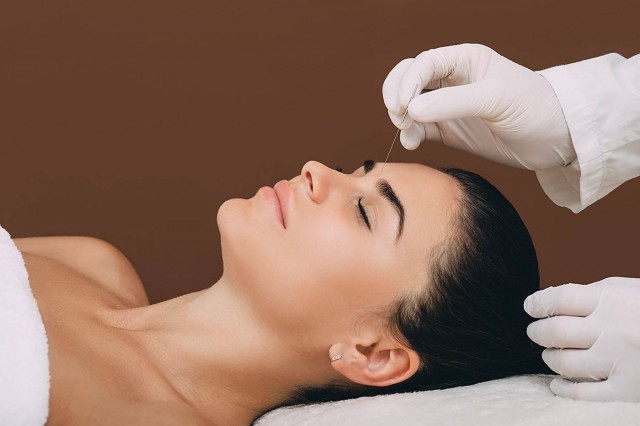 Studiu: Acupunctura reduce durerile de cap asociate cu migrena