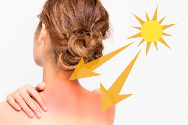 Remedii naturiste pentru arsurile solare