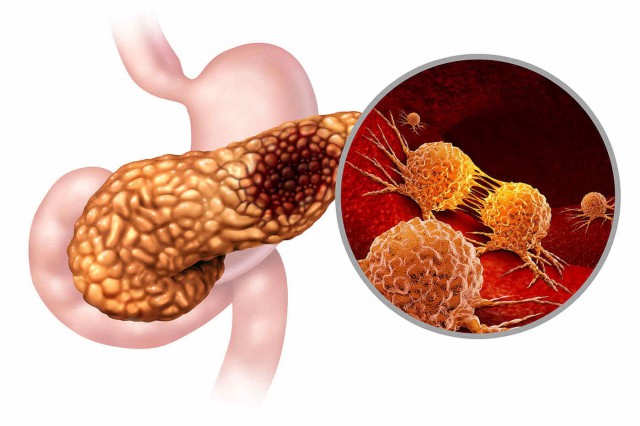 Studiu: Metastaza cancerului de pancreas ar putea fi prevenită