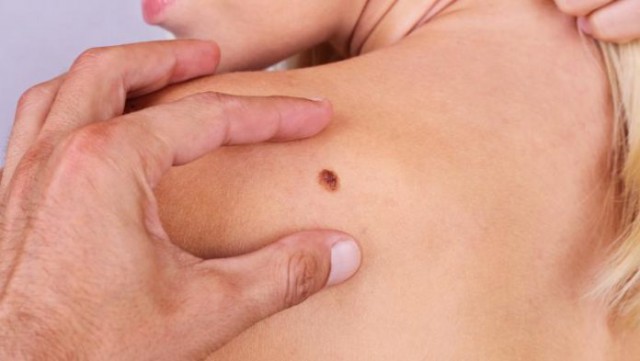 Cancerul de piele. Tipuri de cancer de piele, diagnostic, tratament