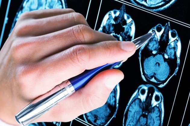 Prima clasificare a crizelor de epilepsie cu ajutorul unui model matematic
