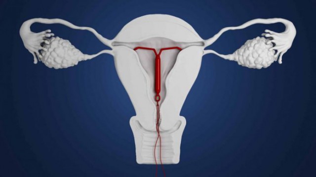 Steriletul hormonal - efecte secundare și contraindicații