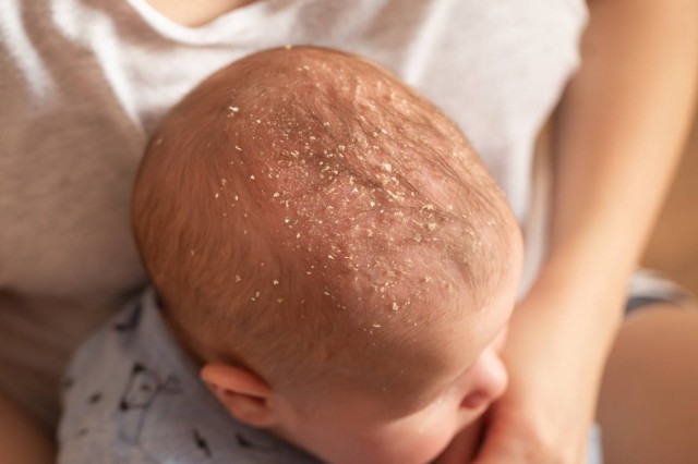 Dermatita seboreică a sugarului - ce tratamente dau rapid rezultate