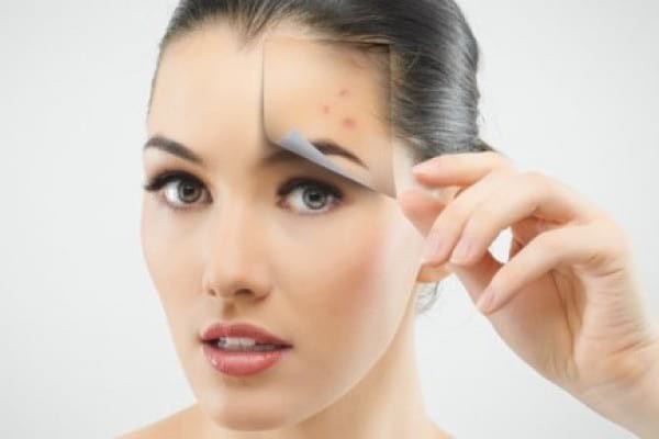Cicatricile post-acnee - cum scăpăm de ele?