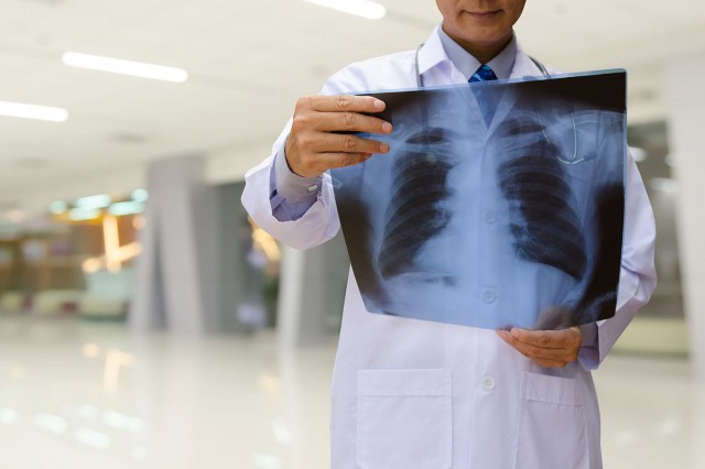 Studiu: Speranțe noi în tratarea fibrozei pulmonare asociată cu senectutea