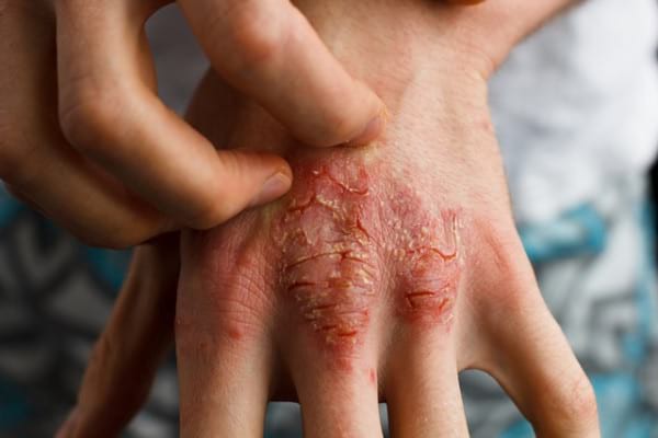 Psoriazis vs cancer de piele - cum deosebești aceste afecțiuni