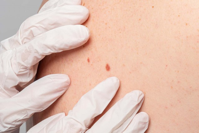 Ai pete hepatice pe piele? Iată ce trebuie să știi