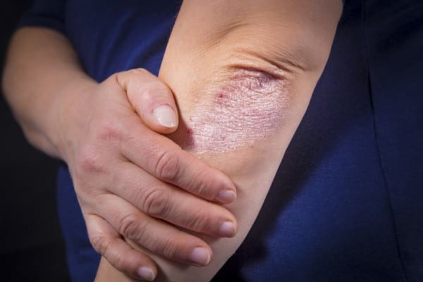 Dietă în psoriazis: cum reduci inflamația din organism