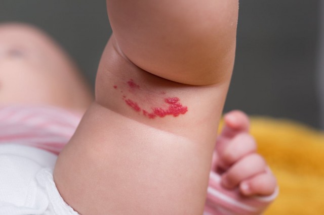 Ce trebuie să știi despre hemangiomul infantil