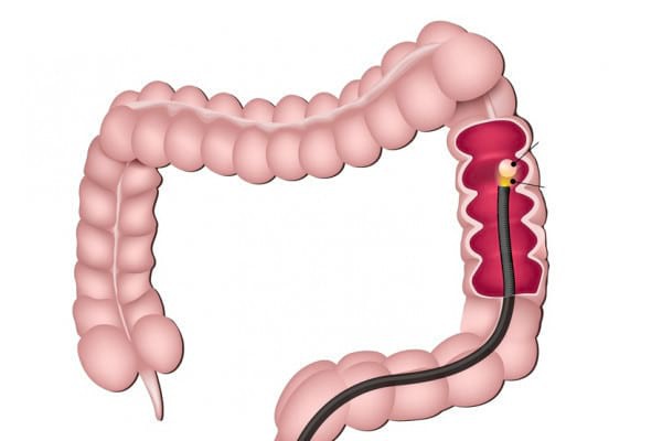 Colonoscopia - metodă de diagnostic, dar și de tratament
