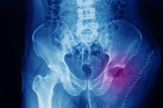 Studiu: Osteosarcomul la copii, asociat cu defecte ale genelor?