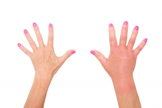 10 cauze ale umflării degetelor de la mâini