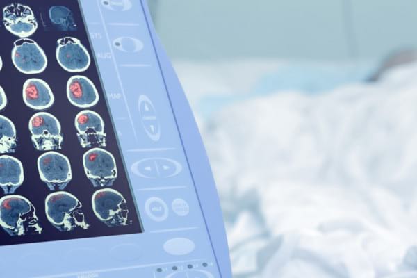 Anticoagulantele pot crește riscul de AVC la cei de peste 65 de ani