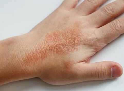 Urticaria la frig - de ce apare și cum se tratează?