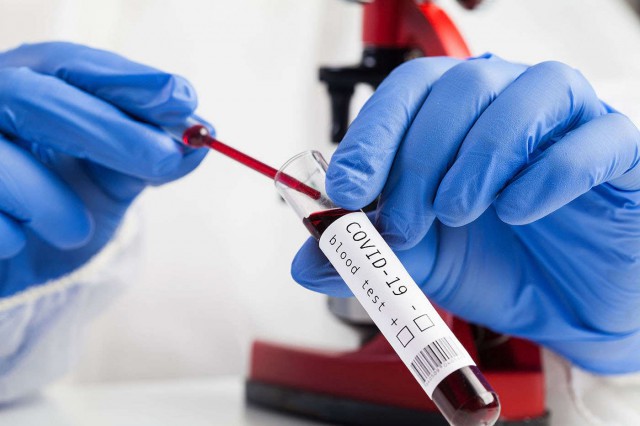 COVID-19 în formă gravă, frecvent asociat cu sindrom inflamator intens manifest și hiperferitinemie
