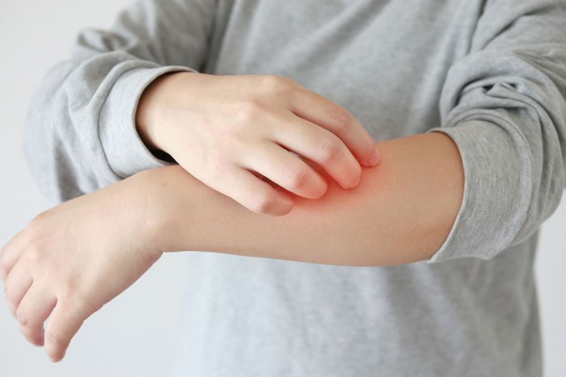 Studiu: Mâncărimile asociate cu eczema, influențate de factorii de mediu